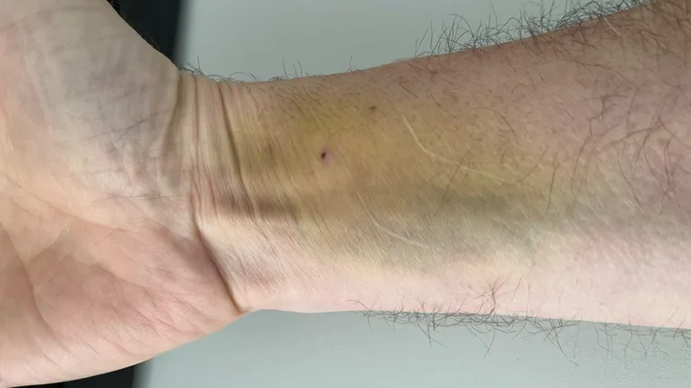 Nach der Untersuchung – der Arm heilt gut